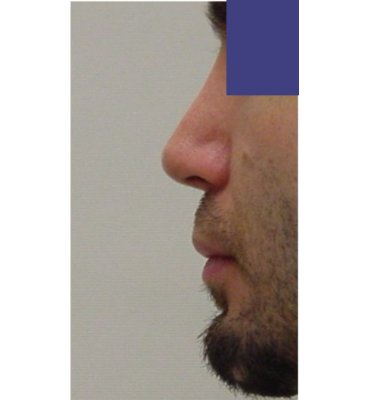 silicone revision rhinoplasty